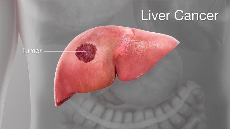 Liver cancer 2